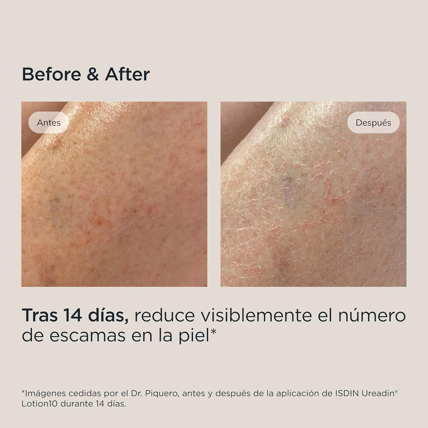 ISDIN UreadinLotion10, Loción Hidratante Para Piel Seca Que Ayuda A Aliviar La Sensación De Tirantez, Formulada Con Un 10% De Urea ISDIN®, Testado Dermatológicamente - 1000 ml - Imagen 7