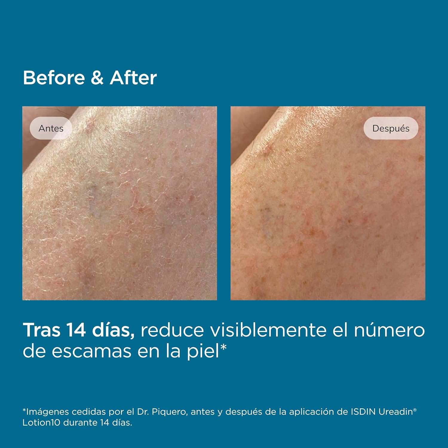 ISDIN UreadinLotion10, Loción Hidratante Para Piel Seca Que Ayuda A Aliviar La Sensación De Tirantez, Formulada Con Un 10% De Urea ISDIN®, Testado Dermatológicamente - 200 ml - Imagen 7